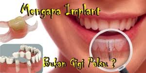 Kira2 brpa biaya nya ,, dan berapa lama pembuatan nya. Mengapa Harus Memasang Implant Bukan Memasang Gigi Palsu Saja Veneer Gigi Kawat Gigi Pemutih Gigi