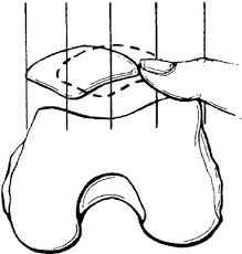 Image result for Patella Mobility Test