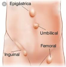 Tapi tahukah anda sebenarnya ia juga boleh berlaku kepada bayi perempuan. Apa Itu Hernia Hernia Krim Rawatan Angin Pasang Hernia ÙÙŠØ³Ø¨ÙˆÙƒ