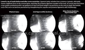 I'm just now realizing i have a slight downward curve right at my glans. Symptoms And Treatments Of Spinal Curvature Problems Caring Medical Florida