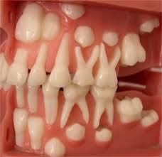 Malformalady Ortodontia Denticao Higiene Dental