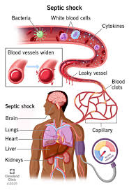 Septic Shock: Symptoms, Causes & Treatment