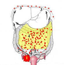 Ovarian cancer signs & symptoms can be hard to detect, but may include abdominal bloating or swelling. Hipec Ovhipec Chemotherapy Ovarian Cancer Of The Ovary Debulking Recurrence Surgery Operation Intervention Treament Therapy Stage 2 Stage 3 Stage 4 Stage Ii Stage Iii Stage Iv Recurrent Surgical Center Centers
