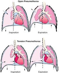 The type of pneumothorax caused by ruptured air blisters is most likely to occur in people between 20 and 40 years old, especially if the person is very tall and underweight. Pulmonary Conditions In Athletes Knee Sports Orthobullets