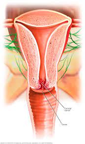 Furthermore, signs and symptoms of pelvic cancer may vary on an individual basis for each patient. Cervical Cancer Symptoms And Causes Mayo Clinic