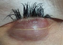 The growth phase (anagen) lasts about 45 days and this is when the lashes are actively growing. Take A Break From Eyelash Extensions Blog By The Lashologist Norwich