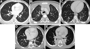 Image result for Atelectasis