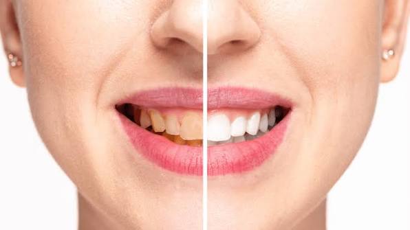 Can Your Diet Impact Your Teeth? | Dr. Nargiz I. Zadeh