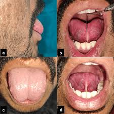Image result for Ankyloglossia