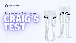 Image result for Femoral Retroversion
