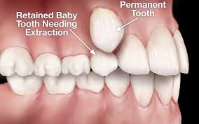 Early stage wisdom teeth real pictures. Tooth Extraction Auckland Wisdom Teeth Removal Auckland