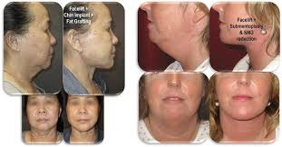 Facelift (Cervicofacial Rhytidectomy) Surgery