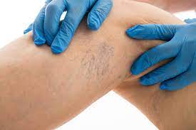 3 Great Tips For Minimizing The Appearance Of Spider Veins Clement Banda Md Dermatologist