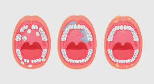 Bleeding, pain, or numbness in the mouth. Oral Cancer Symptoms Markham Markham Dentist Forestbrook Dental