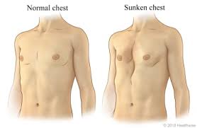 Image result for Pectus Excavatum