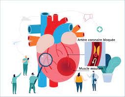 Troubles de connaissance et de la malaise vagal variabilité considérable dans la tumeur cérébrale amyloïde. Crise Cardiaque Infarctus Symptomes Femme Jeune Que Faire