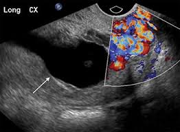 Image result for First Trimester Ultrasound