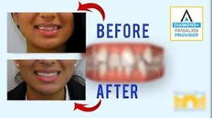 How long does invisalign take to straighten teeth? Invisalign Before And After Crowded Teeth Youtube
