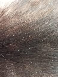 Image result for lice vs dandruff