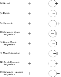 Treatment Of Astigmatism Related Amblyopia In 3 To 5 Year