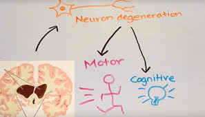 It's passed on (inherited) from a person's parents. Future Of Huntington Disease