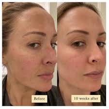 PROGRESS: We started treating this babe while she was pregnant/nursing so  she followed the pregnancy safe regimen for melasma (linked in highlights  under 'pigment regimen') until she was finished nursing. Then we
