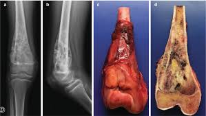 Image result for Osteosarcoma