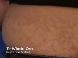 Image result for Postinflammatory Hypopigmentation