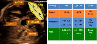 Congenital Diaphragmatic Hernia Cdh Treatment Johns