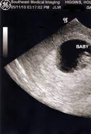 The best treatment for painful gallstones is surgery to remove your gallbladder. Oakland News Update Dgizmo Galbladder Pin On Sad Gallbladder The Awkwardstore Com If You Re Having A Gallbladder Attack It S Important That You Seek Immediate Medical Care