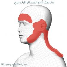 الصداع الارتدادي