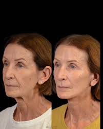 Only 3 weeks after a deep plane lower face and neck lift, this 72 year old  is healing beautifully and already showing off her defined neck and  jawline. She still is very