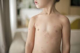 Windpocken bei erwachsenen verlaufen schwerer als bei kindern. Windpocken Ursachen Symptome Und Therapie Emedi