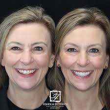 This smile transformation is extra special as it's one of our FABULOUS FZ  Dentistry team members! After a childhood accident caused years of trouble  with her front tooth, Patti is now glowing