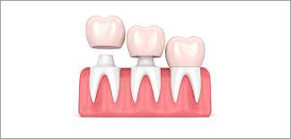 We did not find results for: Crown Cementation Tips For Reducing Excess Cement