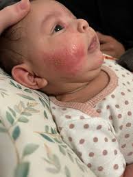 Image result for red rash face