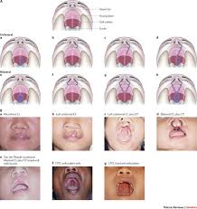 Image result for Cleft Lip