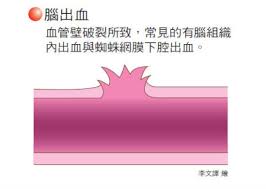 ＜片頭痛を和らげる簡単ストレッチ＞ まっすぐ前を向いた姿勢をとる 左手を頭の上に置く 15秒～20秒間、息を吐きながらゆっくりと頭を左側に倒し、右の首筋を伸ばす 頭をもとの位置にもどし、左手を頭の右斜めうしろ側に置く å‡ºè¡€æ€§è…¦ä¸­é¢¨æ˜¯ä»€éº¼ ä¸€æ¬¡äº†è§£å‡ºè¡€æ€§è…¦ä¸­é¢¨ç—‡ç‹€ æ²»ç™‚ä»¥åŠå¦‚ä½•é é˜² åº·å¥çŸ¥è­˜åº«