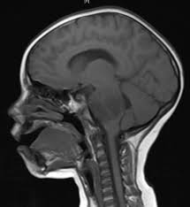 What are brain tumors in children? Childhood Brain Tumors Staging And Prognosis Factors Acco