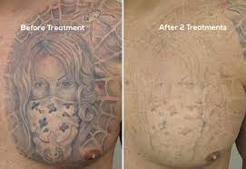 I saw major results, but the ink still remained below the surface. Remove Tattoo Hydrogen Peroxide