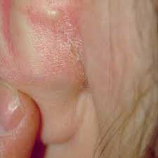 If you've noticed an itchy rash between the folds of your skin, it could be intertrigo. 6 Retroauricular Intertrigo 20 Year Old Man Download Scientific Diagram