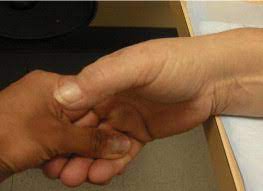 2 participants were diagnosed by history and a positive finkelstein test. Staged Description Of The Finkelstein Test Sciencedirect