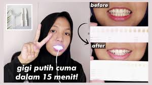 Nyobain Alat Pemutih Gigi Instan Teeth Whitening Kit Indonesia Youtube