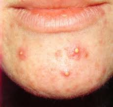 Due to the omnipresence of dioxins, all people have background exposure, which is not expected to affect human health. Warum Tritt Nach 30 Akne Im Gesicht Auf Was Fuhrt Zu Akne Pickeln Und Hautausschlagen Altersbedingte Hormonelle Veranderungen