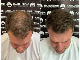 Smp mobile and its team of experts have stepped forward with an outstanding service of. Scalp Micropigmentation Hair Tattooing Hair To Ware