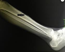 Image result for periostitis