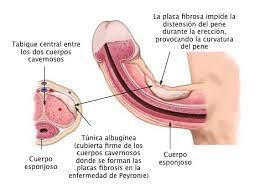 La enfermedad de peyronie, conocida comúnmente como la enfermedad de la curvatura del pene afecta a uno de cada diez hombres y provoca disfunción eréctil en un 40 % de. Enfermedad De Peyronie Ecured