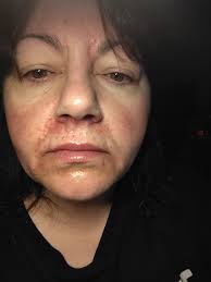 What is causing my perioral dermatitis?