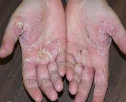 Since being founded in 1924 they have helped to diagnose, treat and rehabilitate people affected by leprosy. Oaxaca Entre Los 18 Estados Con Casos De Lepra Ssa Tiempo Digital