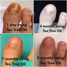 Toenail fungus is also scientifically called as onychomycosis. Robot Check Toenail Fungus Remedies Nail Fungus Cure Tea Tree Oil